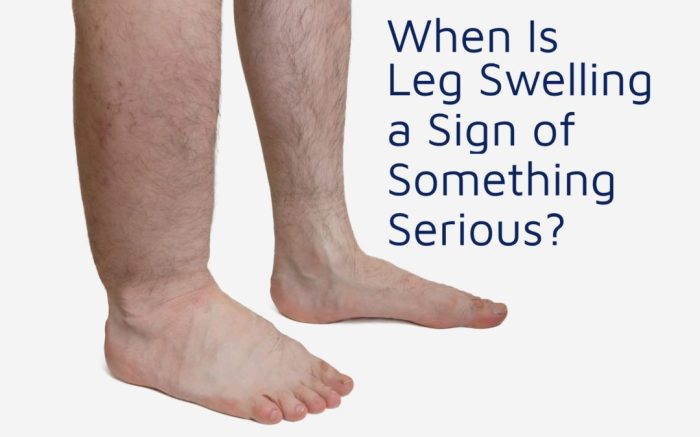 Different Causes Of Lower Back Swelling Or Redness Lower back pain and swelling in legs and feet