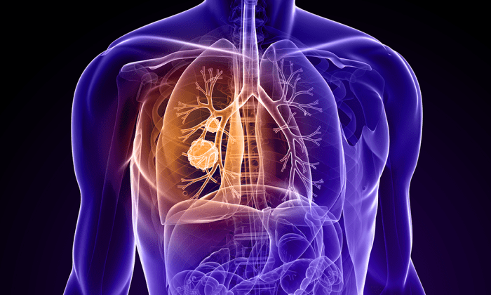 Primary lung cancer. Colored chest x-ray showing primary lung cancer ... What is primary lung cancer