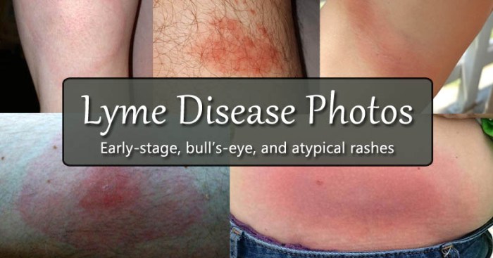 Lyme disease rash pictures
