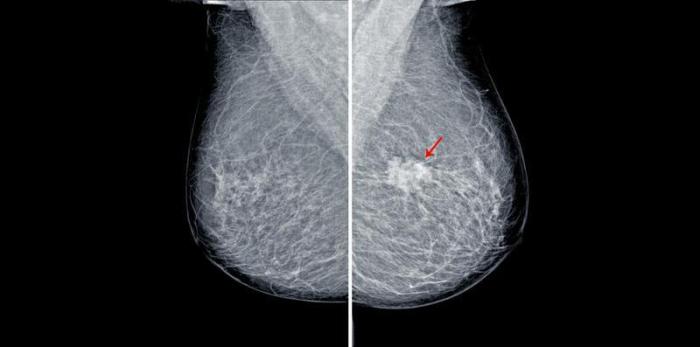 A New and Improved Mammogram? | Reader's Digest Mammogram images descriptions and details