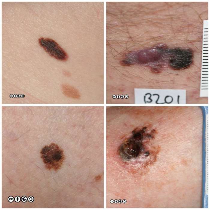 The Spread of Melanoma Metastasis Melanoma staging what it means and reveals