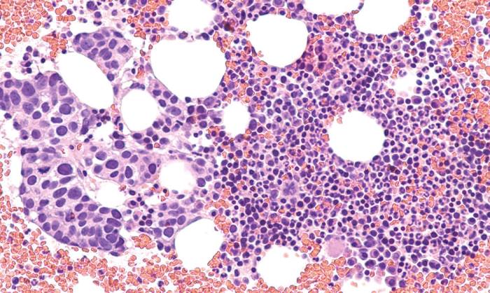 Types of Breast Cancer A Comprehensive Guide
