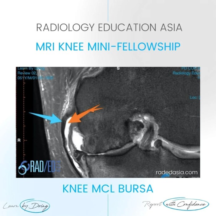 MCL BURSA KNEE MRI MEDIAL COLLATERAL LIGAMENT - Radedasia Mcl tear medial collateral ligament injuries