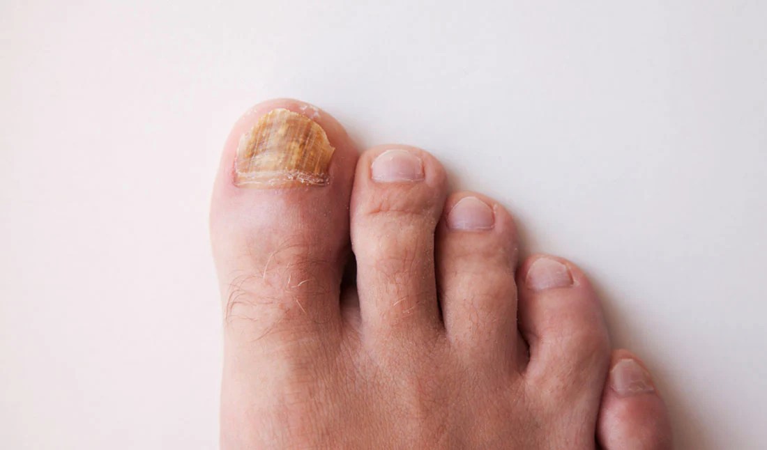 Types of toenail fungus