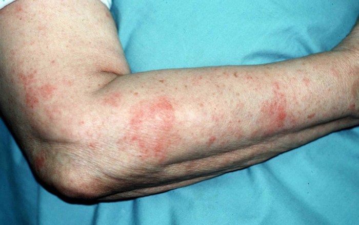 Is eczema an autoimmune disease