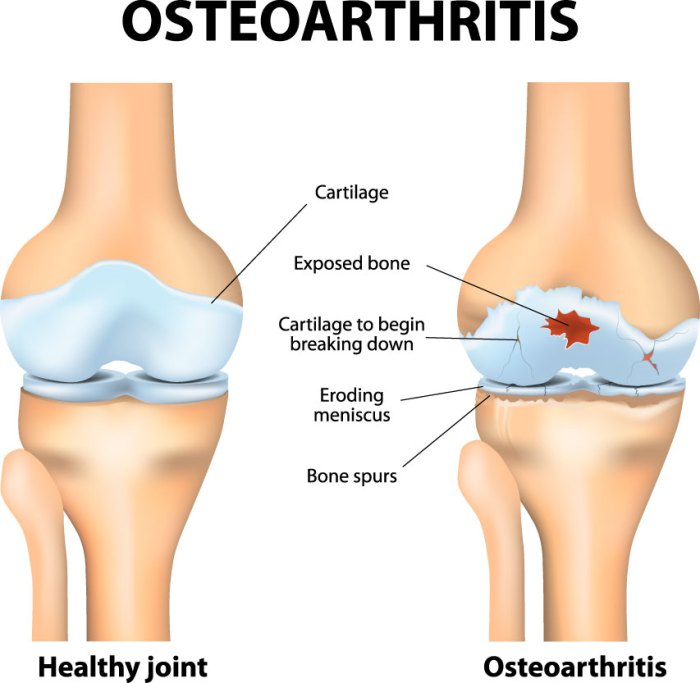 Treatments for loss of cartilage in knee