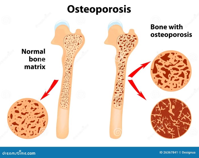Osteoporosis Fractures Treatment and Prevention A Comprehensive Guide