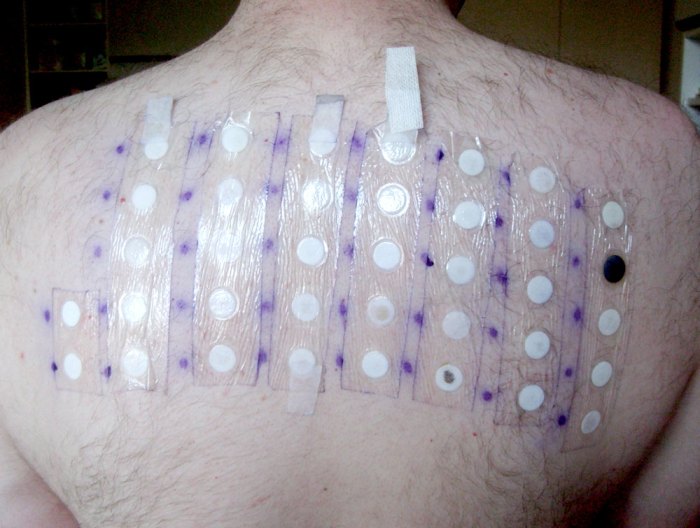 Patch Testing for Contact Dermatitis A Comprehensive Guide