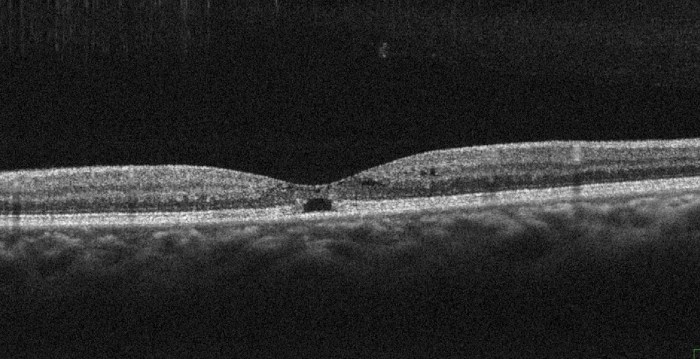 Macular telangiectasia eye disease