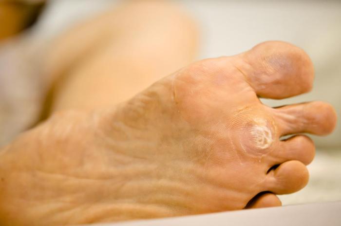 Photos of Plantar Warts on Feet A Visual Guide