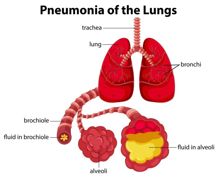 Pneumonia vs Lung Cancer A Deep Dive