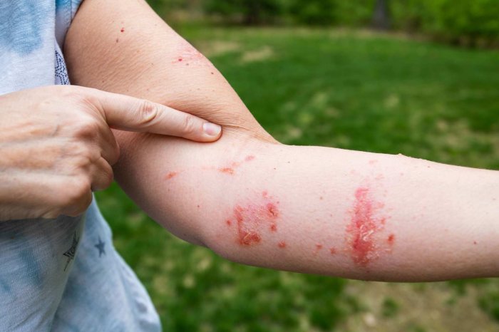 5 Plants That Cause Rashes - AZ Animals Plants that cause rashes