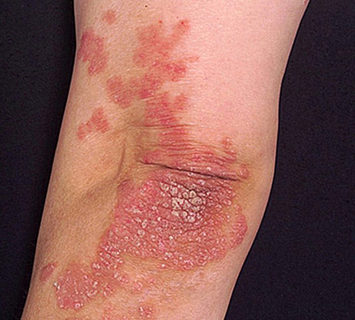 How Psoriasis Is Diagnosed A Comprehensive Guide