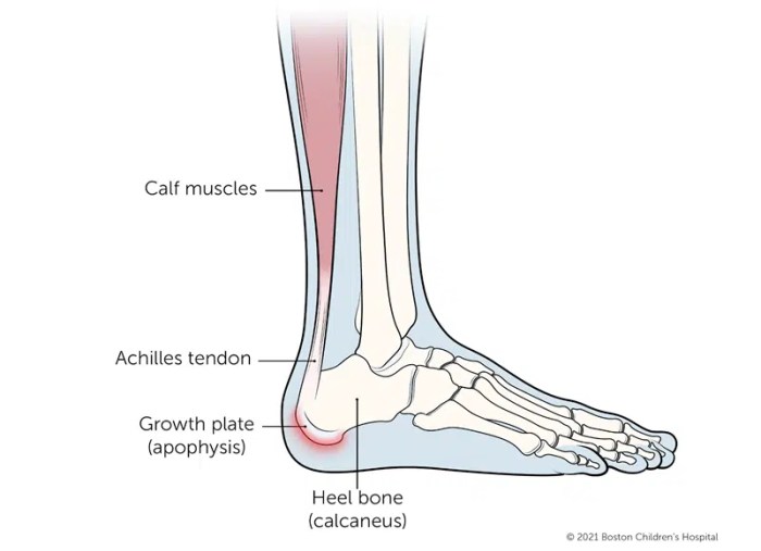 Heel pain when walking