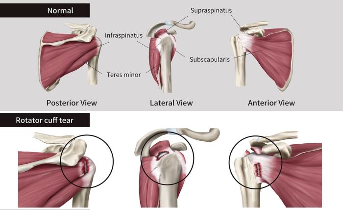 Understanding Partial Rotator Cuff Tears