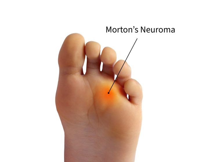 Morton's Steakhouse Menu Prices + Power Hour (2023) Mortons neuroma common cause of foot pain