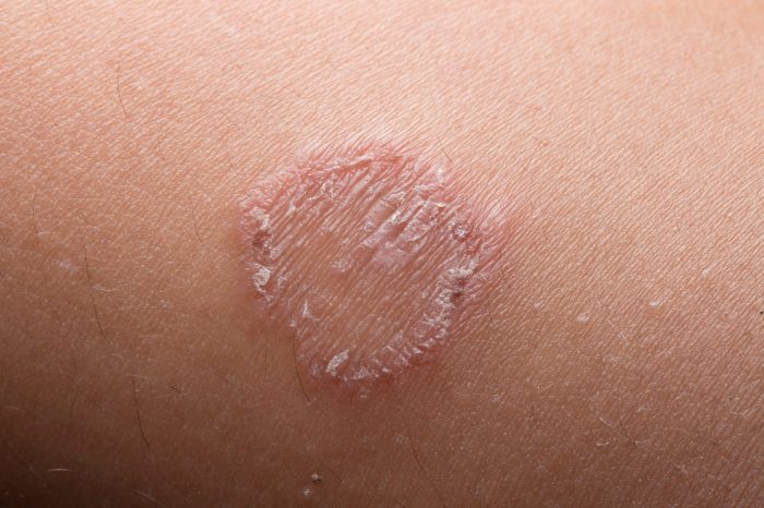 Ringworm can be sexually transmitted