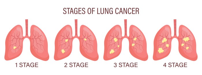What to Expect During End Stage Lung Cancer What to expect in the final stages of lung cancer