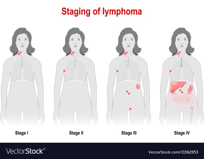 PPT - Lymphoma Overview PowerPoint Presentation, free download - ID:4501266 How is lymphoma treated