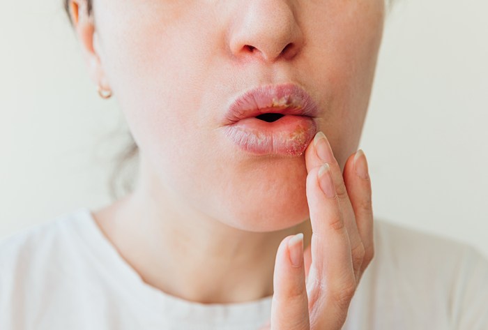 Itchy Swollen Lips Rash Reddit - Infoupdate.org What causes swollen lips