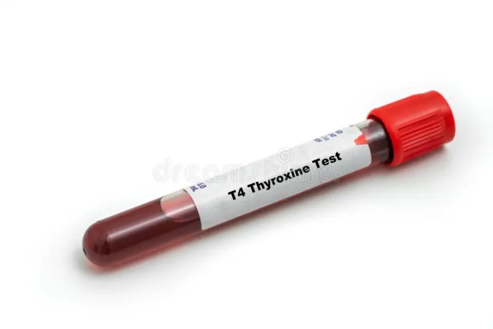 Thyroxine test stock image. Image of experiment, hyperthyroidism - 70355743 Total thyroxine test uses