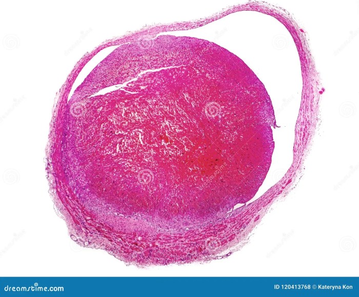Thrombus Inside Blood Vessel, Light Micrograph Stock Photography | CartoonDealer.com #120413768 What is a thrombotic stroke