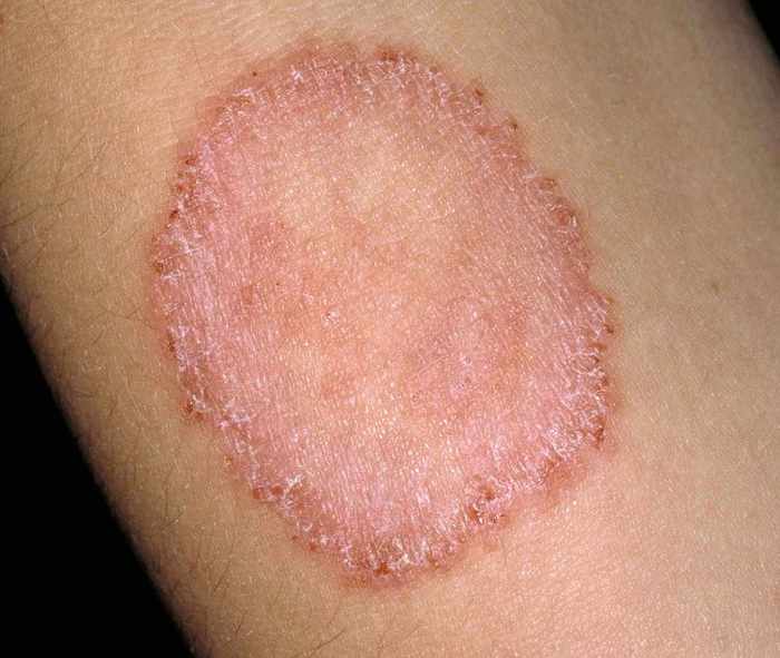 Ringworm can be sexually transmitted