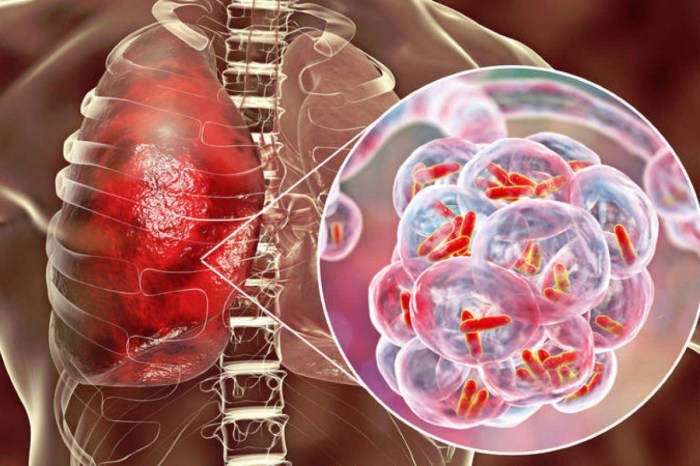 Pulmonary Tuberculosis Symptoms Causes And Treatments - vrogue.co Tuberculosis outbreak in kansas