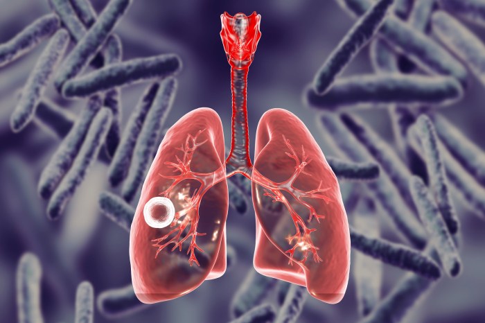 Tuberculosis outbreak in kansas