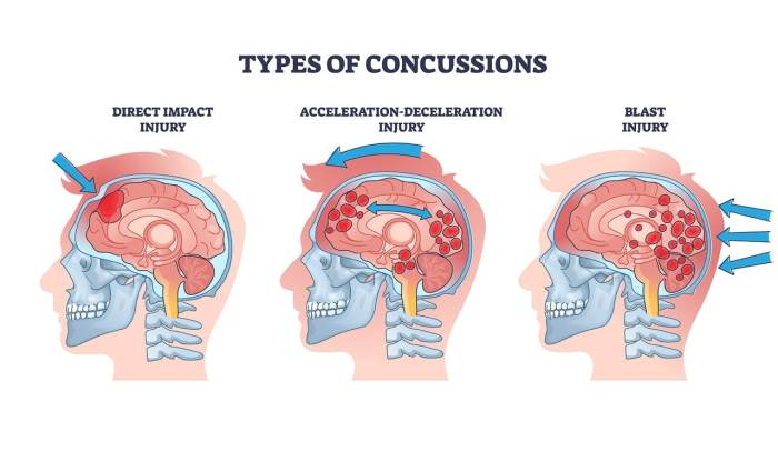 Difference between concussions and traumatic brain injuries