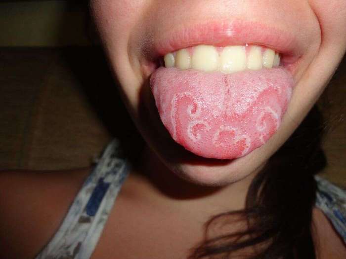 Causes of a sore tongue and throat