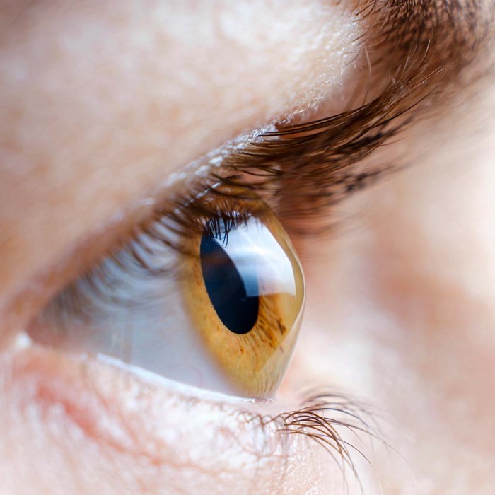 Melanoma of the eye