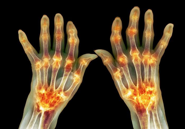 What Does Arthritis Look Like? A Visual Guide