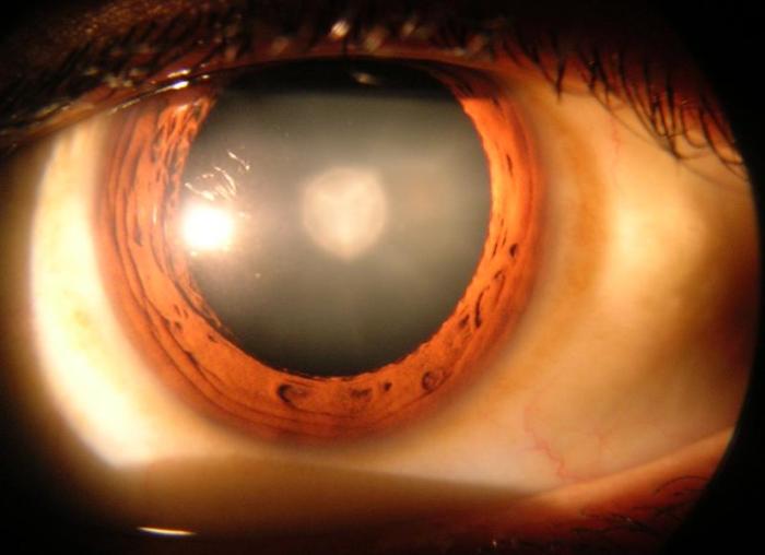 Cloudy vision in one eye