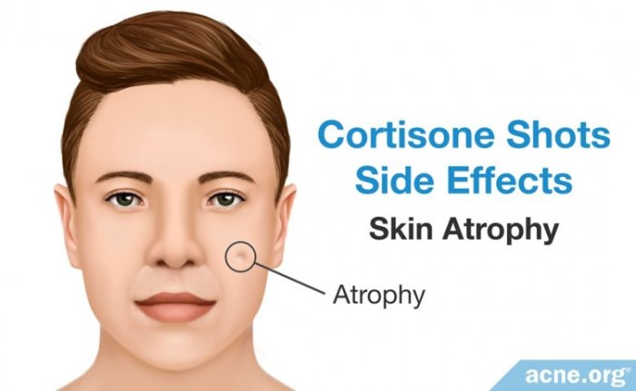 Cortisone Shots for Severe Acne - Nodules and Cysts - Acne.org What is a cortisone flare