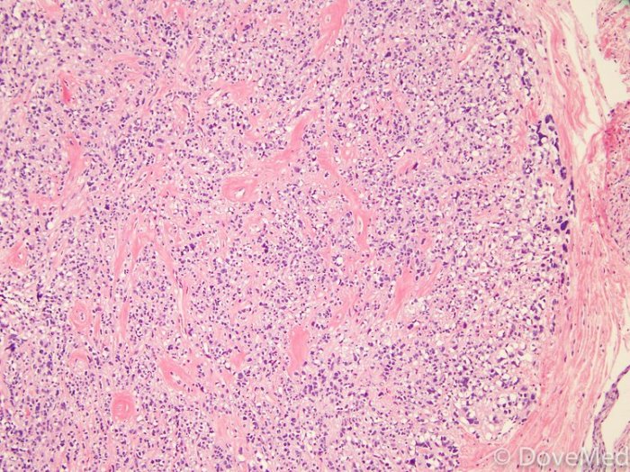 What is metaplastic breast cancer
