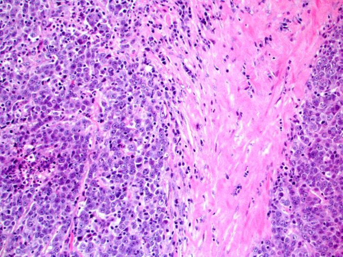 What is metaplastic breast cancer