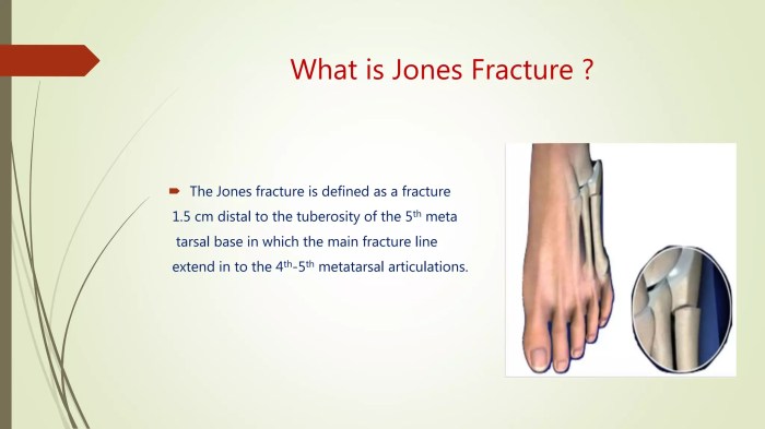Physical therapy after a jones fracture