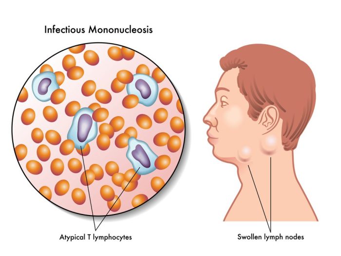 How is mono diagnosed