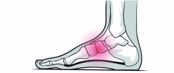 Jones Fracture| Injuries| KneeRover Physical therapy after a jones fracture