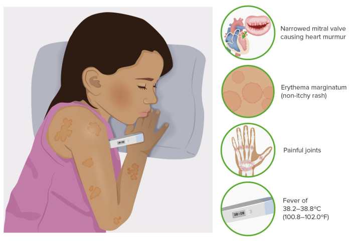 Rheumatic Fever | Concise Medical Knowledge Rheumatic fever symptoms causes treatment