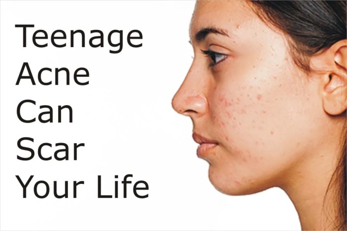 How to Get Rid of Teen Acne - Dr. Health Clinic - Homepage Keep teen acne to a minimum