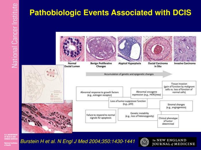 PPT - Ductal Carcinoma In Situ (DCIS) PowerPoint Presentation, free ... Ductal carcinoma in situ dcis