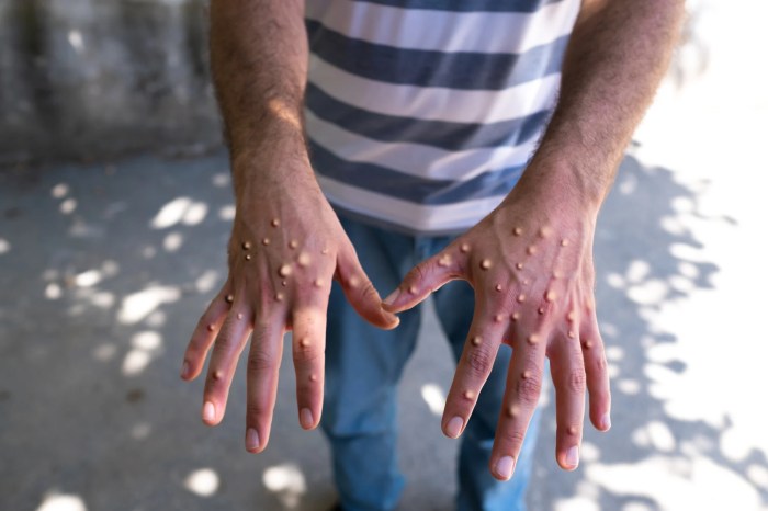 Could monkeypox (mpox) become the next global pandemic? – Monash Lens What does monkeypox rash look like