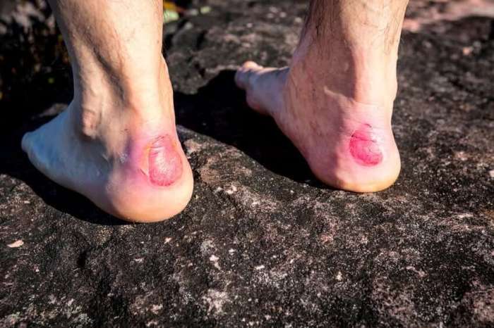 Everything You Need to Know About Blisters Vesicle causes and treatments