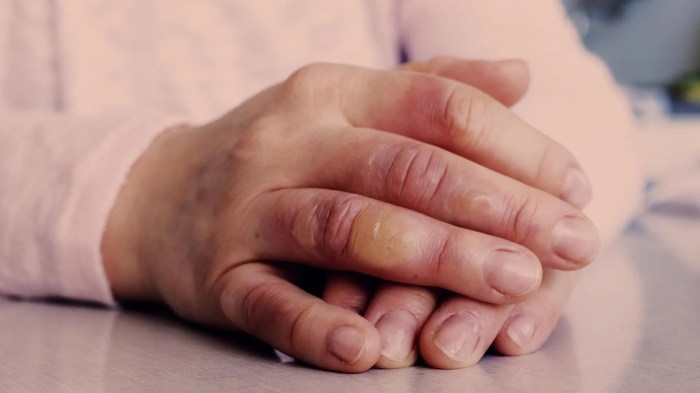 Try these home remedies to get rid of blisters Vesicle causes and treatments