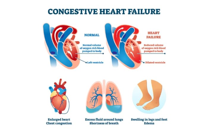 Cbd and congestive heart failure