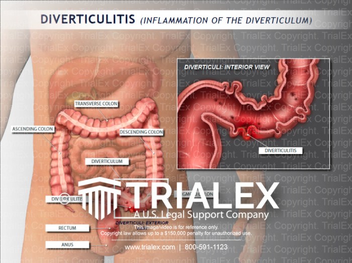 A - Perforated sigmoid diverticulitis: sigmoid colon displaying ... Sigmoid diverticulitis effect on the colon and diagnosis