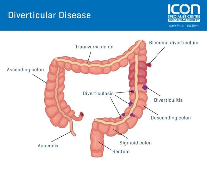 Anatomy of Sigmoid Colon Showing Diverticulitis - TrialQuest Inc. Sigmoid diverticulitis effect on the colon and diagnosis