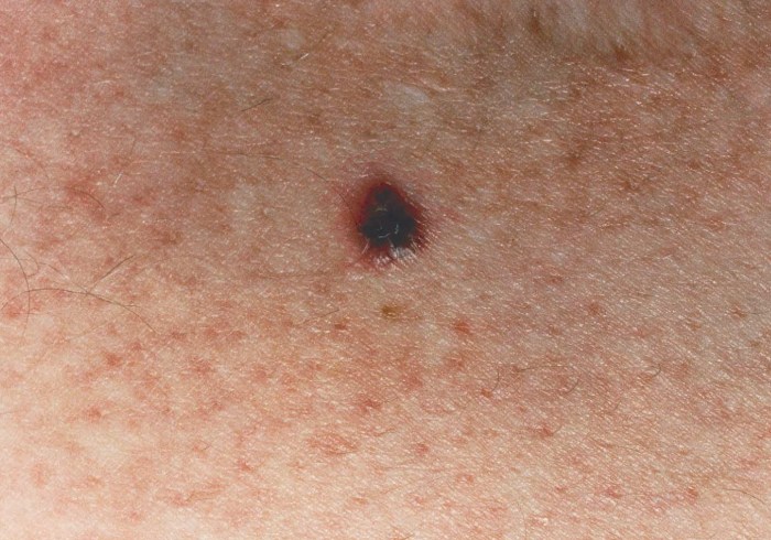 Melanoma pictures by stages, stage 0-1-2-3-4 melanoma pictures ... Melanoma pathology report the mitotic rate